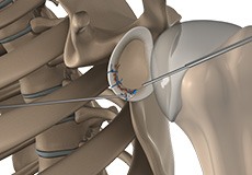 Arthroscopic Bankart Repair 