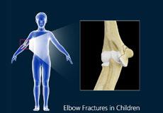 Elbow Fractures 