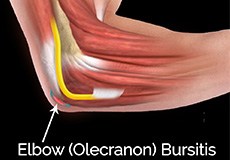 Elbow (Olecranon) Bursitis