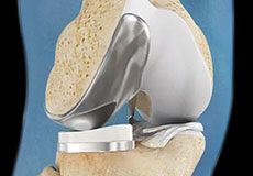 Unicompartmental/Partial Knee Replacement