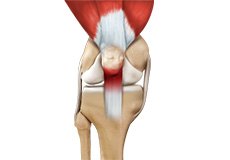 Patellar Tendinitis