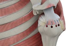 Rotator Cuff Repair 