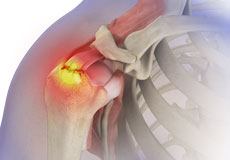 Rotator Cuff Tear 