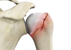 Shoulder Fracture Care 