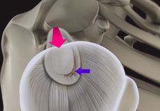 Shoulder Labral Tear 