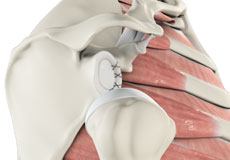 Shoulder Labrum Reconstruction 