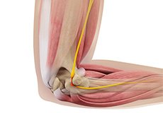 Ulnar Nerve Releasen